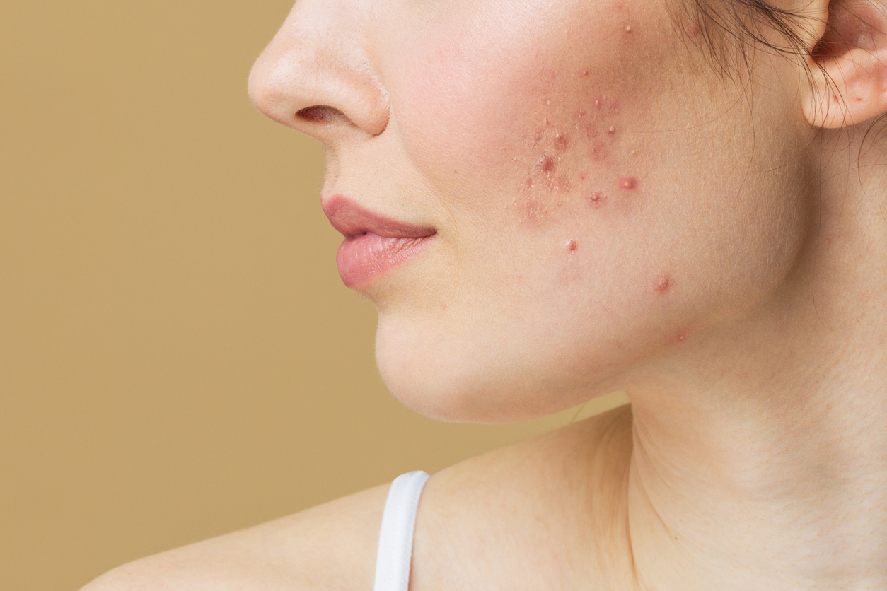 Acne Treatment