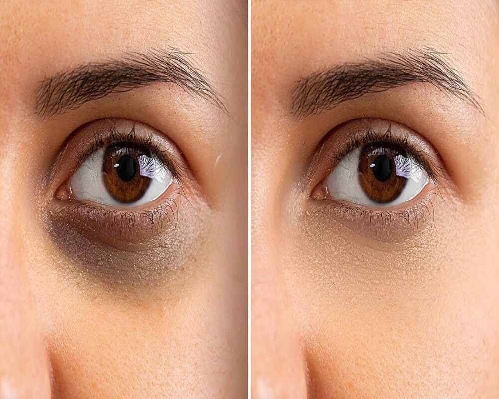 Dark Circles