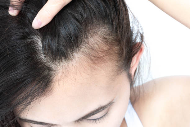 Hair Fall