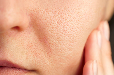 Pores treatment